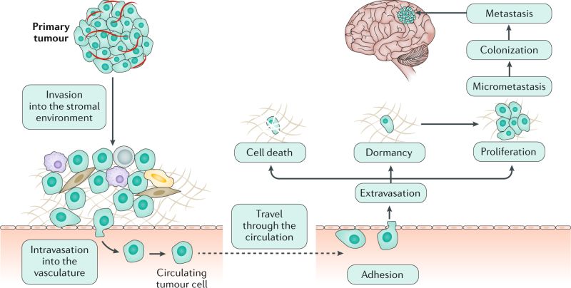 Brain Metastasis