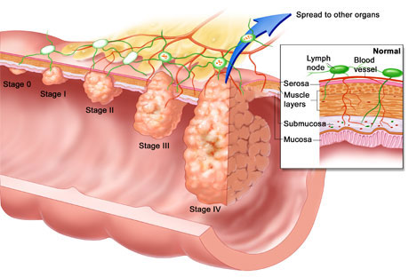 colon cancer staging