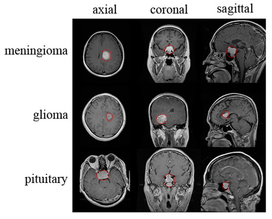 brain tumors