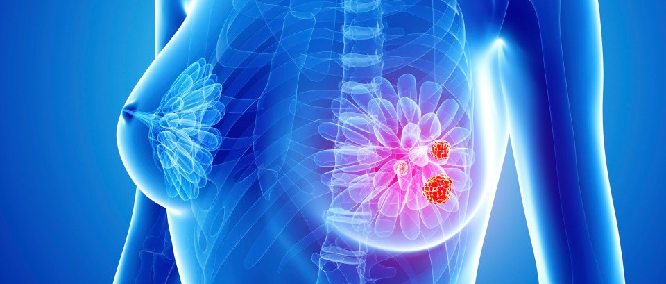 Imlunestrant + abemaciclib likely to become a new 2L treatment option for HR+/HER2- Metastatic breast cancer