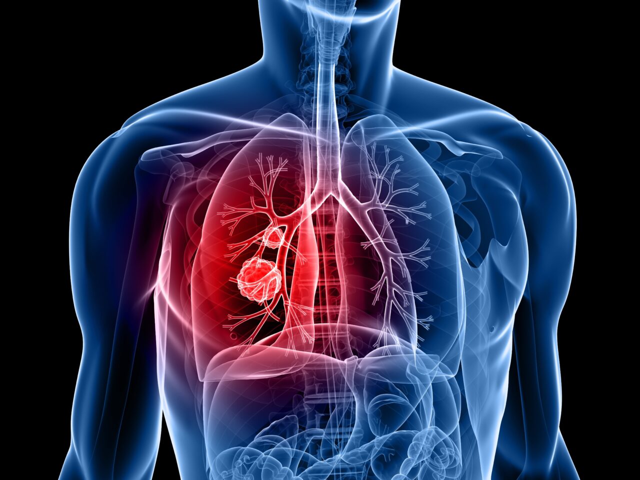 Amrubicin + irinotecan vs cisplatin + irinotecan for SCLC