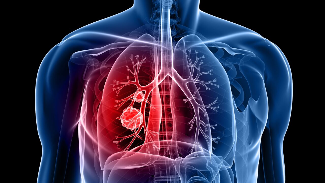 A major step forward in introducing a national lung cancer screening programme – Lung Cancer Europe