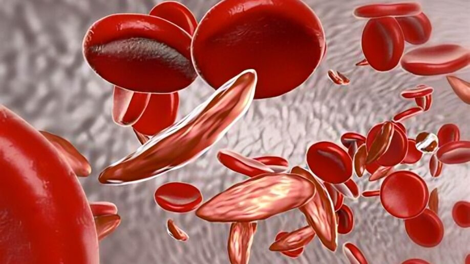 Hydroxyurea Reaffirmed as First-Line Choice in Sickle Cell Density Care