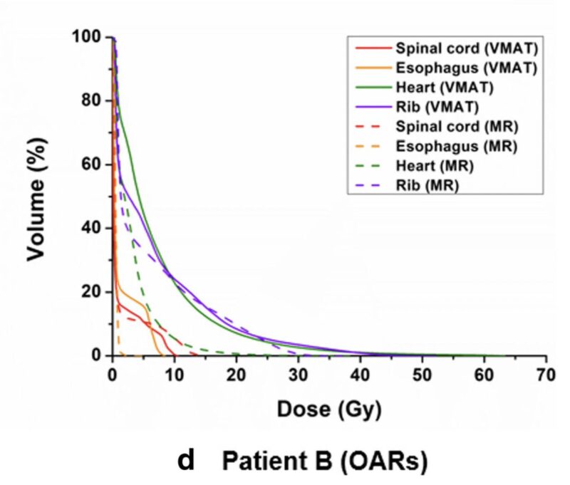 Drew Moghanaki: IMRT with MR-linac and VMAT for lung SABR