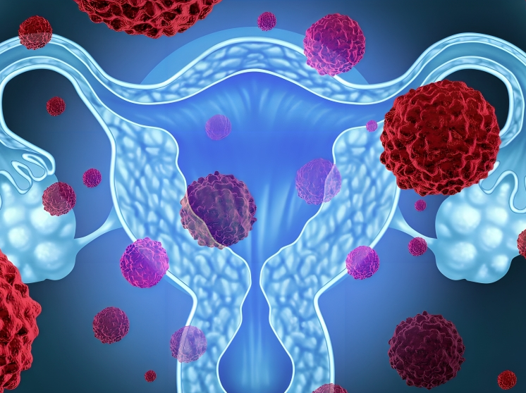 Shahrin Ahmed: Deeper understanding of postmenopausal bleeding and endometrial cancer