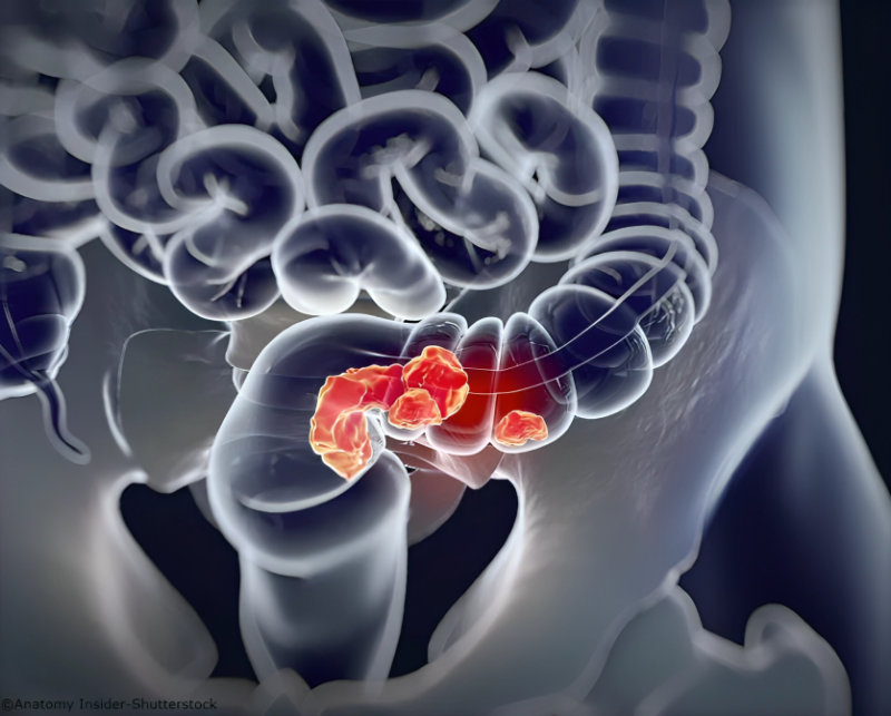 Reza Ghalehtaki: TNT is the new standard of care for LARC