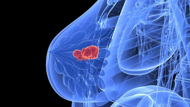 Sahar Mansour: AI Detects Hidden Breast Carcinomas, an Egyptian Experience