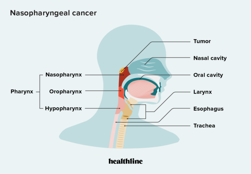 nasopharyngeal ancer symptoms