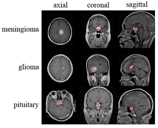 Brain Cancer 