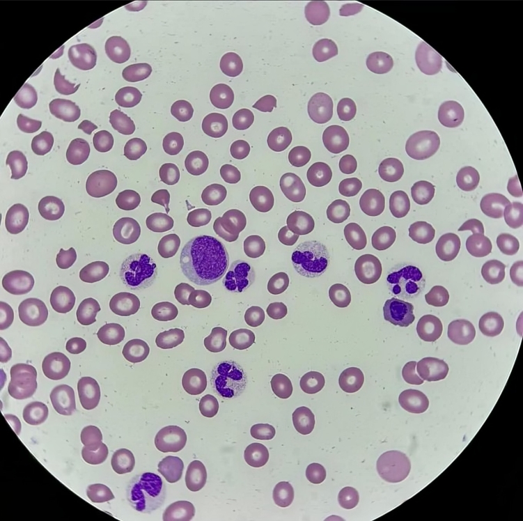 Nico Gagelmann: Recognizing Methotrexate Toxicity - A Case of Severe Anemia in a patient with Rheumatoid Arthritis