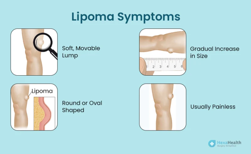 Lipoma Symptoms