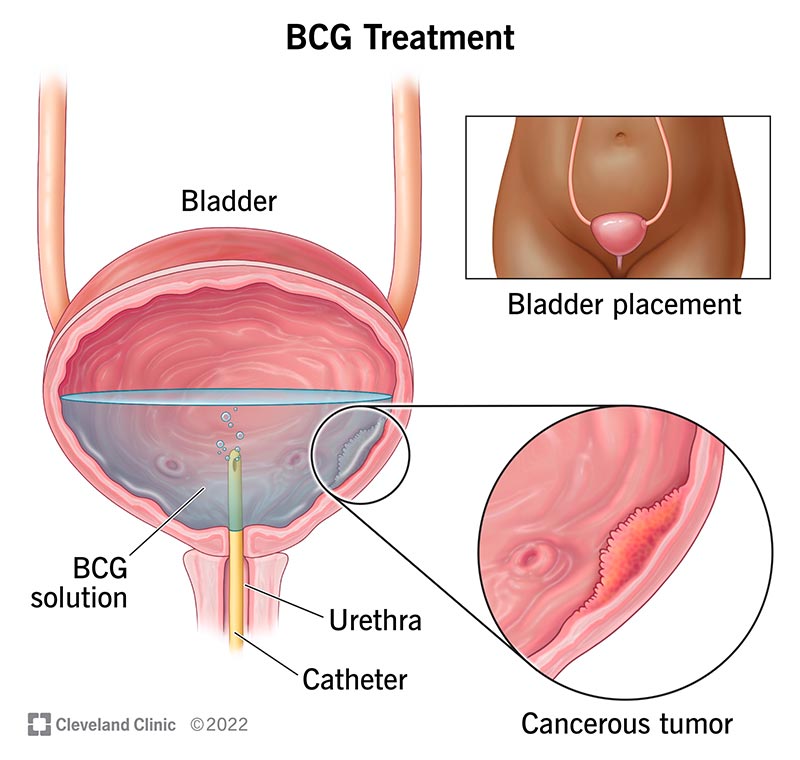 bcg immunotherapy for bladder cancer