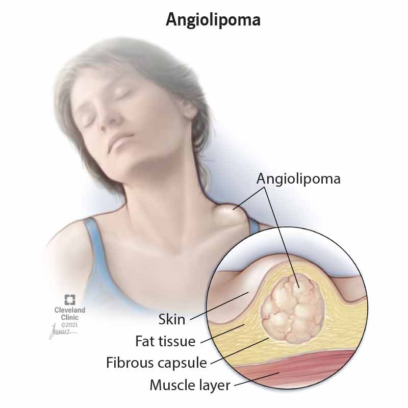 Angiolipoma