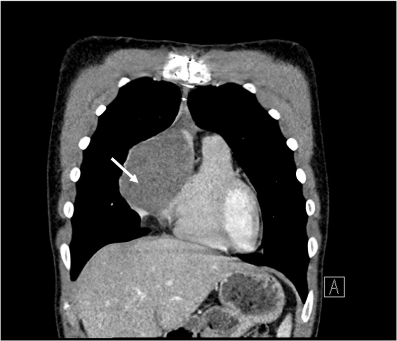 CT coronal slice confirming increase in size of the cardiac angiosarcoma (arrow)