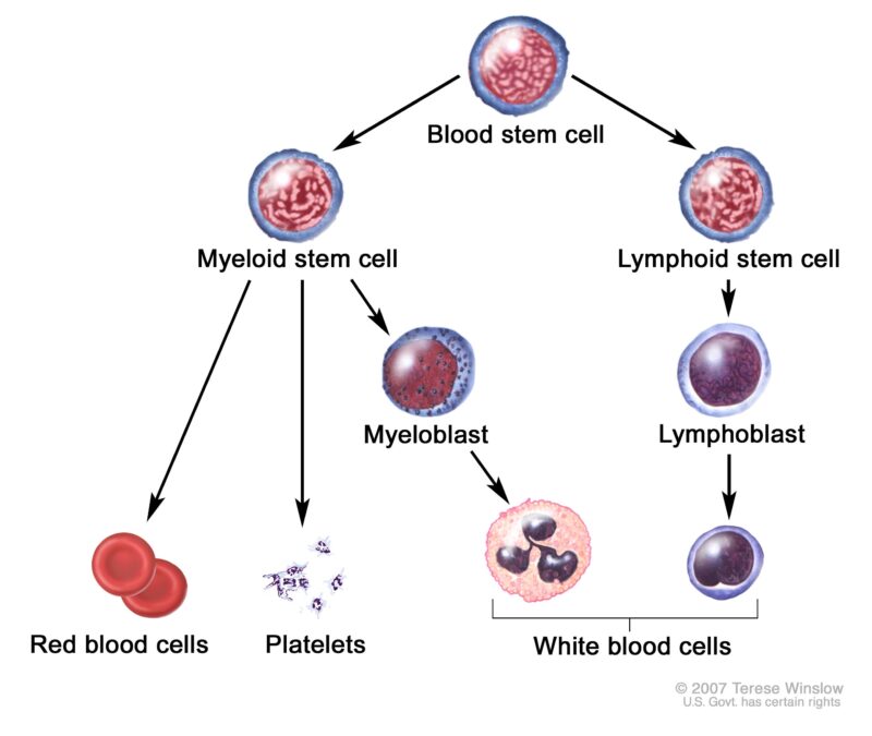 acute myeloid leukemia