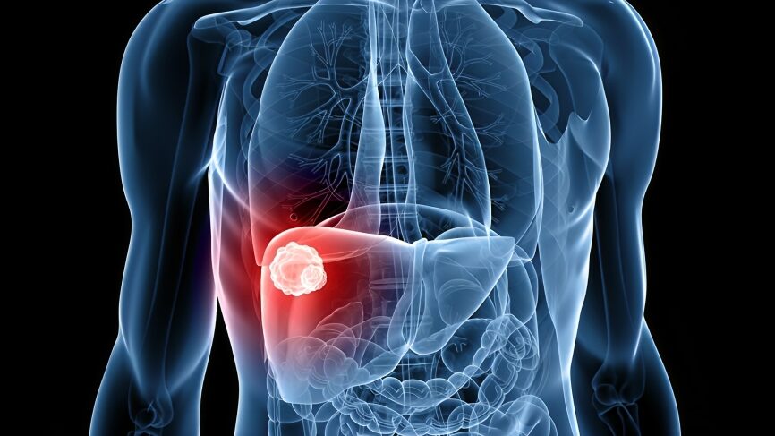 Julie Torode: Knowing Hepatitis Status is The First Step to Stopping Liver Cancer