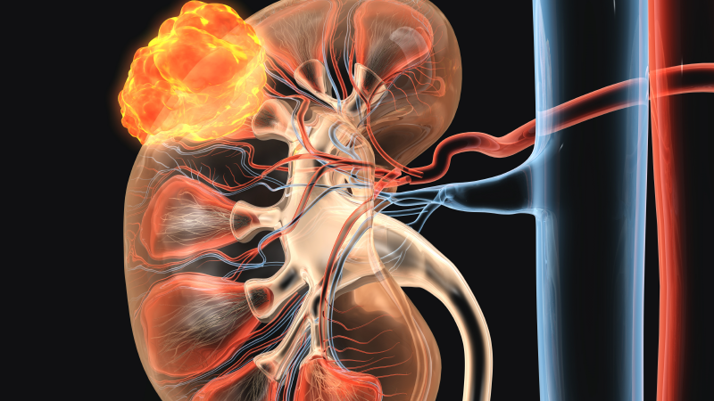 Molecular Analysis of Renal Cell Carcinoma Sites