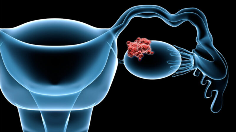 GSK Announced Landmark Results from FIRST Trial in First-Line Advanced Ovarian Cancer