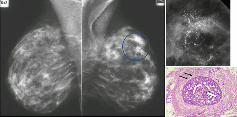 Ductal carcinoma in situ