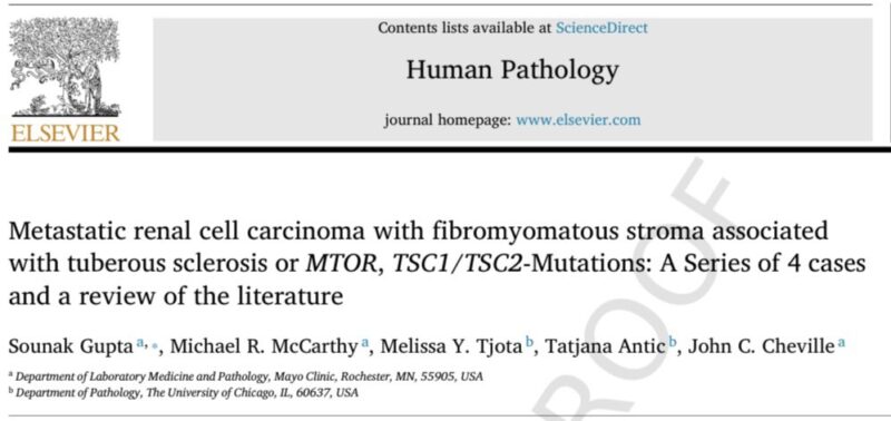 Sounak Gupta: mRCC with Fibromyomatous Stroma associated with Tuberous Sclerosis