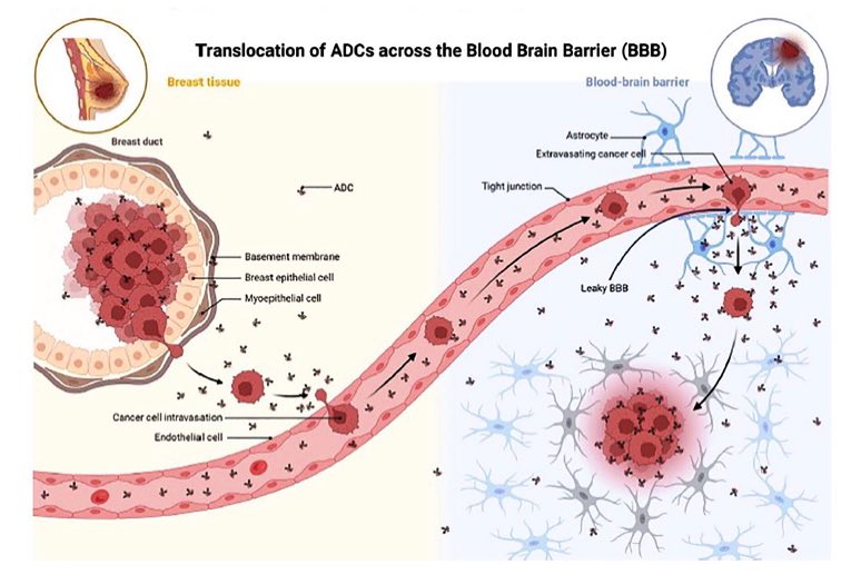 Role of antibody drug conjugates in the treatment of patients with breast cancer brain metastases