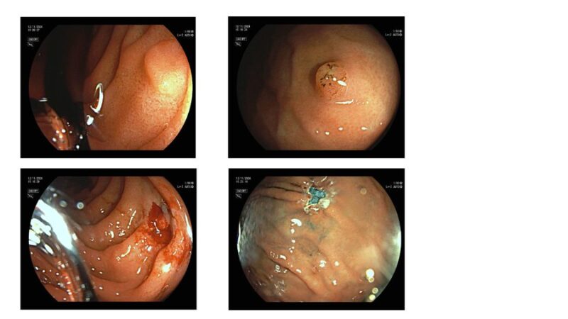 Gastric Cancer Awareness Month 2024