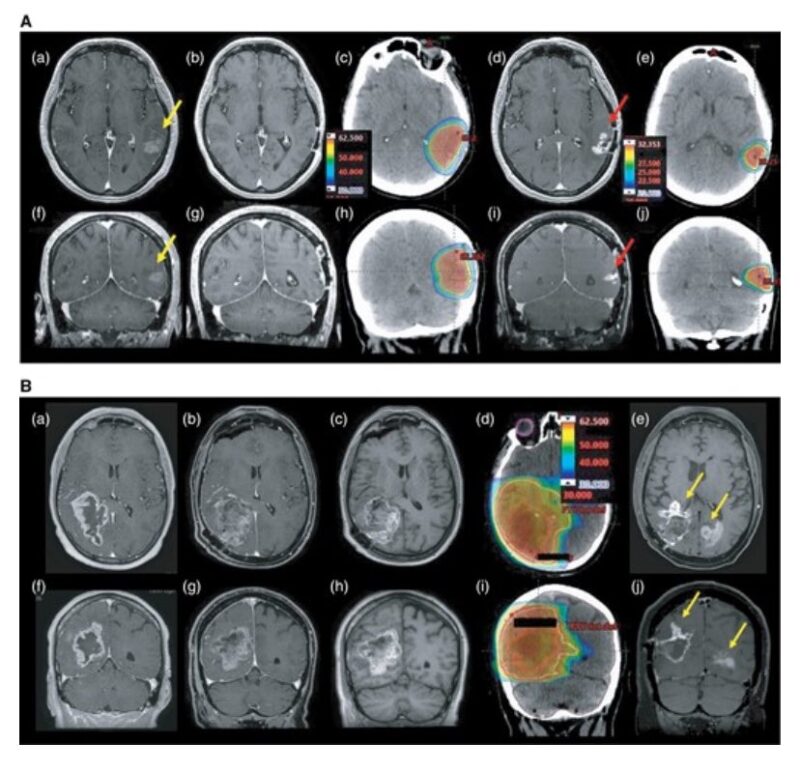 The role of reirradiation in recurrent glioblastoma 