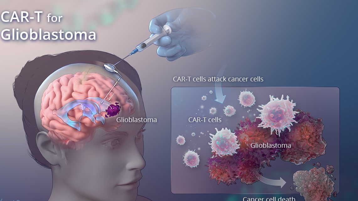 Shahrin Ahmed: CAR-T cells as a new treatment for Glioblastoma