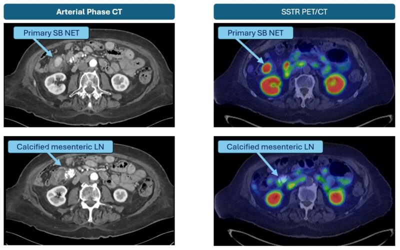 Thor Halfdanarson: Classic NET imaging from the Monday clinic