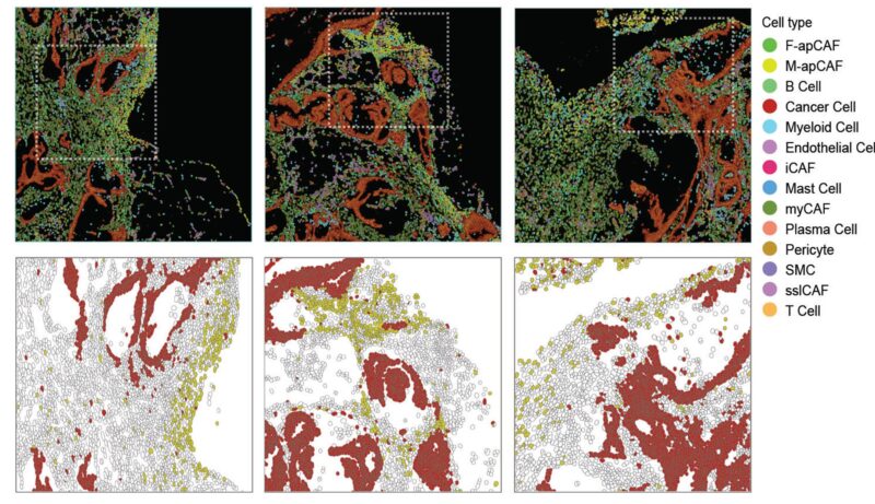 The Spatial Atlas of Antigen-Presenting CAFs in Solid Cancers