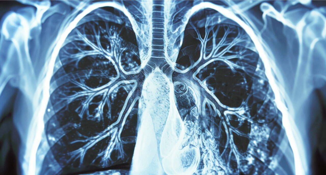 Closing the gap in lung cancer care – Color