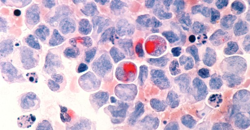 Researchers at the ICR have identified a promising treatment target for Acute Myeloid Leukaemia