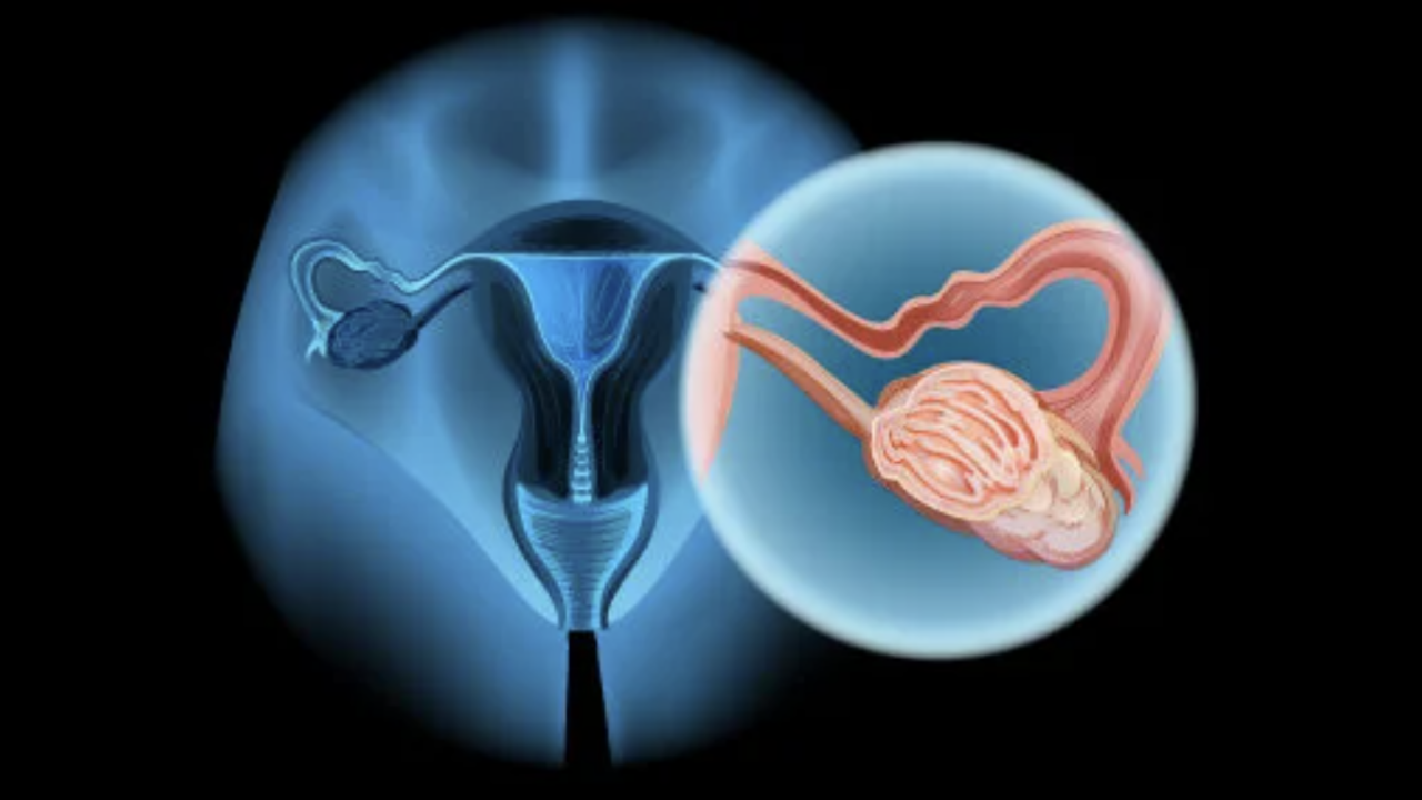 Assessment of Predisposition Genes in High-Grade Serous Ovarian Carcinoma via Germline and Tumour Sequencing