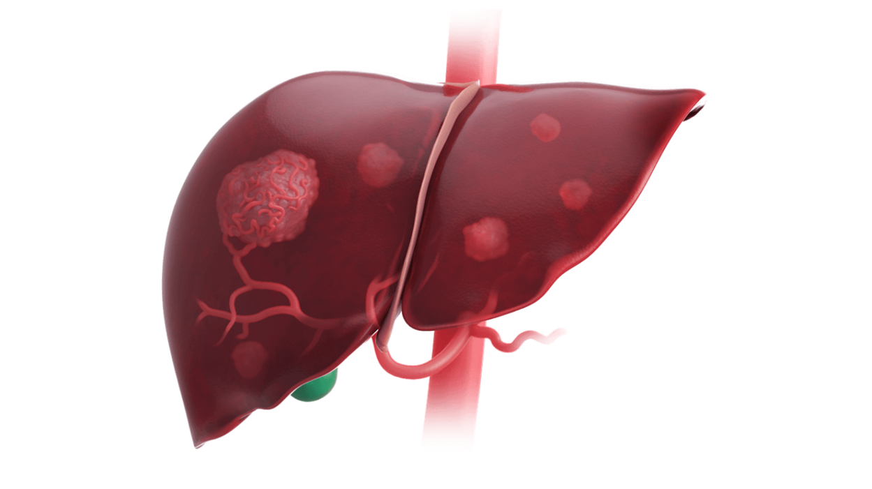 Liver Transplantation for Cholangiocarcinoma After Chemotherapy and SIRT