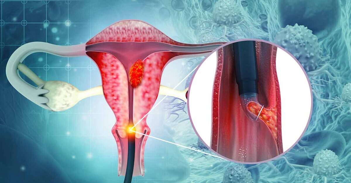 Pembrolizumab-induced vasculitis in a 70 year old woman with endometrial cancer