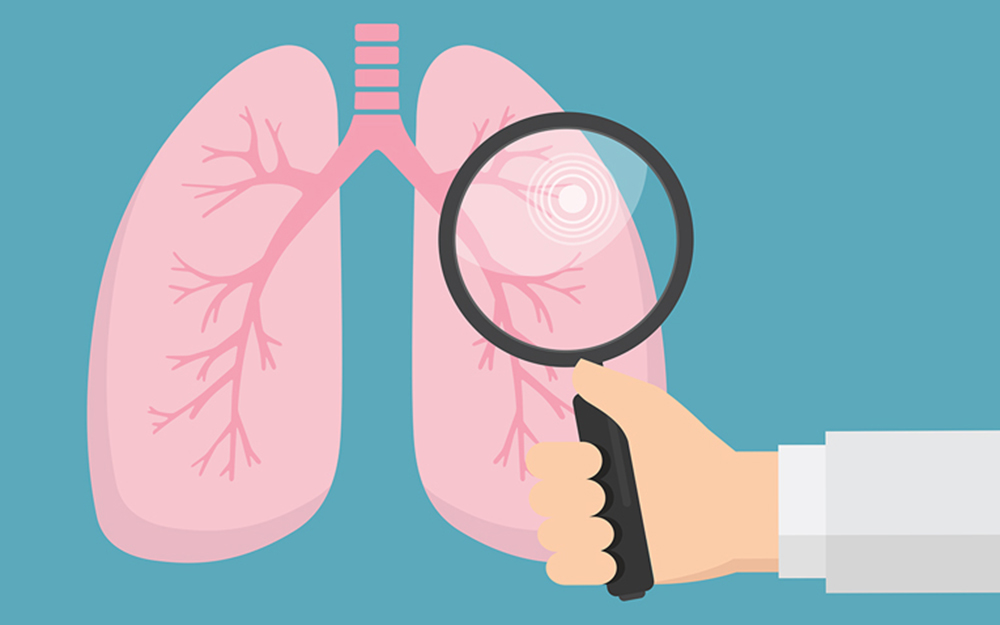 LDCT screening for lung cancer substantially reduces mortality from lung cancer