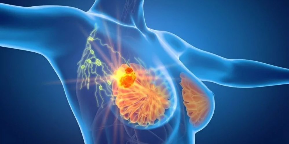 Patient Insights on Recurrence in Hormone Receptor-Positive Breast Cancer – Dana-Farber’s Breast Oncology Center