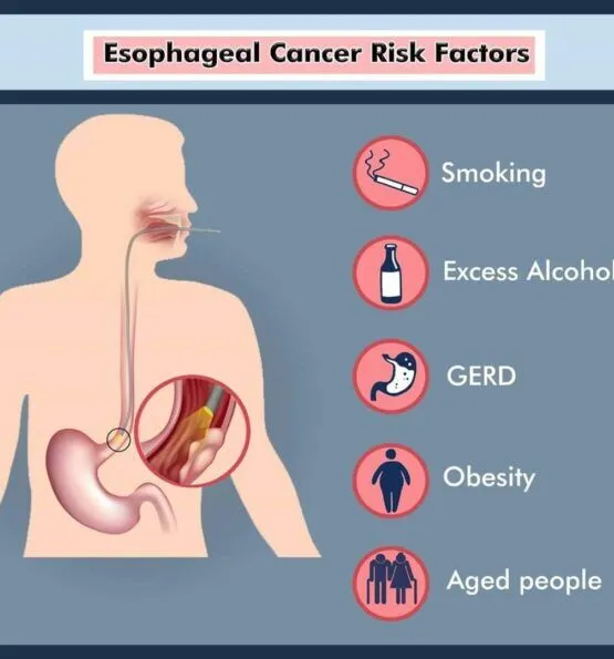 Risk Factors of Esophageal cancer