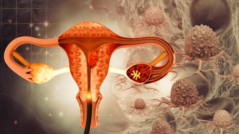 Akhil Santhosh: Minimally Invasive versus Abdominal Radical Hysterectomy for Cervical Cancer
