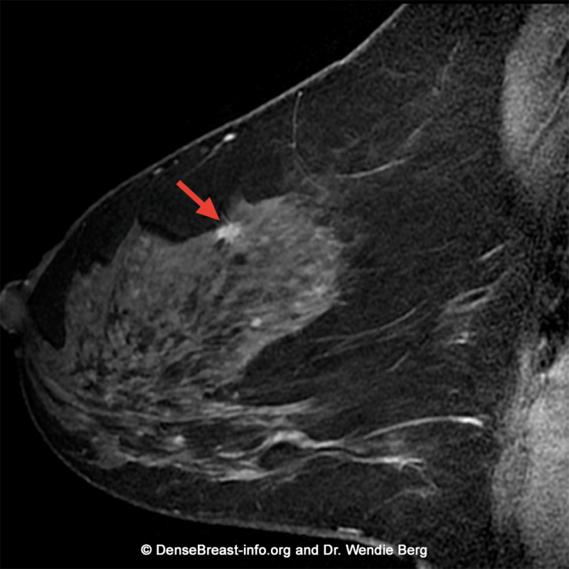 MRI early stage of breast cancer