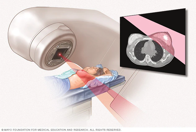 breast cancer radiation therapy