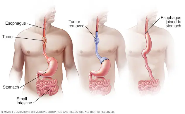 Surgery for esophageal cancer