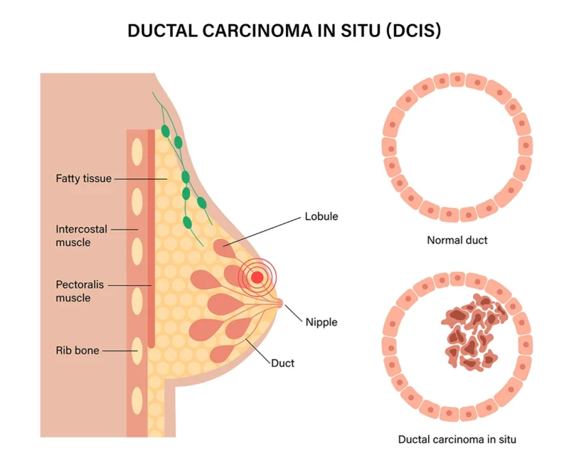 Ductal Carcinom in situ