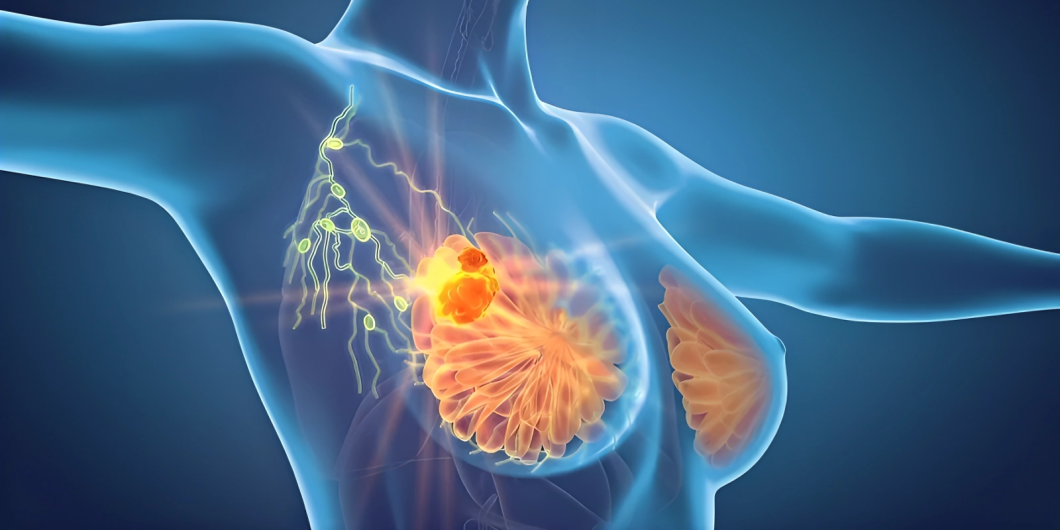 Prevention of Brain Metastases HER2-positive Breast Cancer