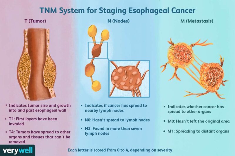 TNM for Esophageal Cancer