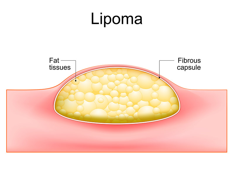 Lipoma: Symptoms, Causes, Stages, Diagnosis and Treatment - OncoDaily