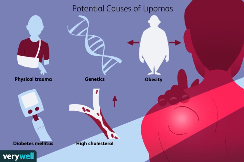 Lipoma: Symptoms, Causes, Stages, Diagnosis and Treatment