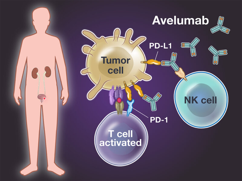 avelumab bladder cancer immunotherapy