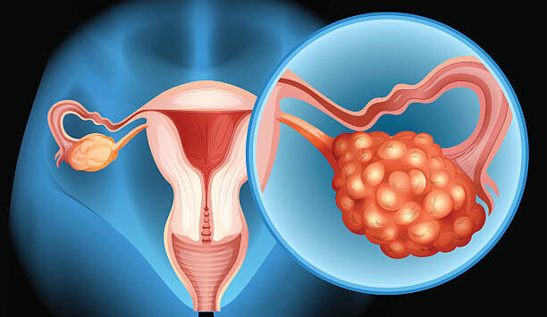 Tumor-derived cytokines create microenvironments that enable ovarian cancer treatment evasion