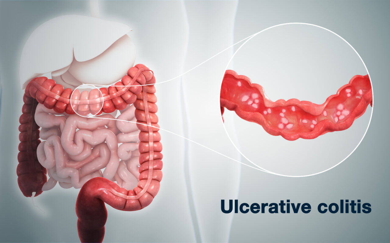 Cancer risk linked to p53 in Ulcerative Colitis